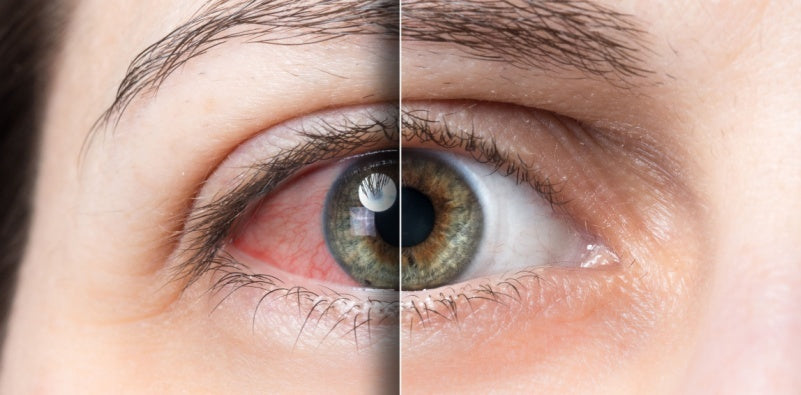 Eye Drops