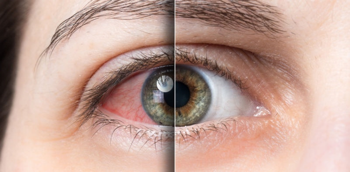 Eye Drops